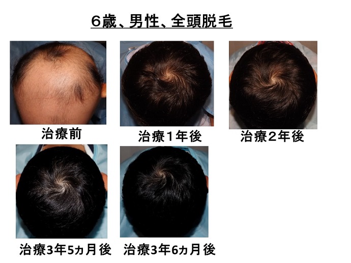 円形脱毛症　病院